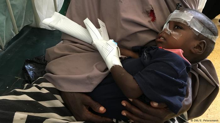 A child with a bandaged head and hand which hold the needle and feeding tube (DW/S. Petersmann)