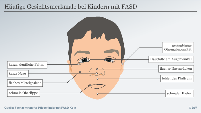 Typisch Fas Syndrom Gesicht Bilder www.dw.com