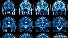 Kernspinaufnahmen eines Gehirns
