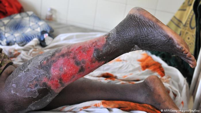 The badly burned leg of a skin bleaching victim (AFP/Getty Images/Seyllou)