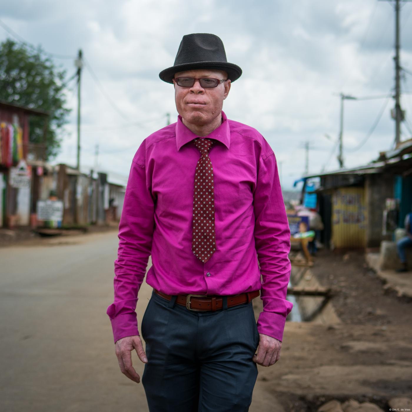 Pulse: Accepting young people with albinism in Kenya
