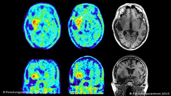 MRT- und PET-Bilder des menschlichen Gehirns (Foto: Forschungszentrum Jülich)