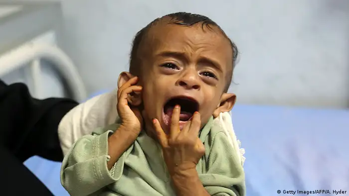 Jemen Hodeidah Unterernährte Kinder