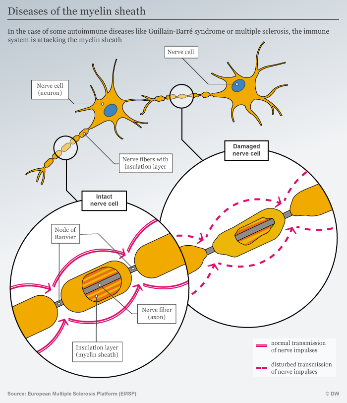 Guillain Barre Syndrome A Sudden Paralysis Of The Arms And Legs Science In Depth Reporting On Science And Technology Dw 13 07 21