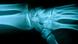 A X-ray image showing the bones of a person's wrist A X-ray image showing the bones of a person's wrist