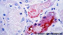 Using immunohistochemical (IHC) technique, this photomicrograph revealed some of the cytoarchitectural histopathologic changes associated with a Nipah virus infection, in this case, affecting an unknown animal’s kidney tubules. Nipah virus, is a member of the family Paramyxoviridae, is related but not identical to Hendra virus. Nipah virus was initially isolated in 1999 upon examining samples from an outbreak of encephalitis and respiratory illness among adult men in Malaysia and Singapore. Its name originated from Sungai Nipah, a village in the Malaysian Peninsula where pig farmers became ill with encephalitis. | Verwendung weltweit, Keine Weitergabe an Wiederverkäufer.