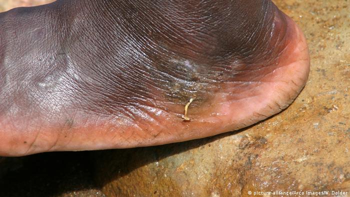 Afrika -Guinea Wurm (photo-alliance / Arco Images / W. Dolder)