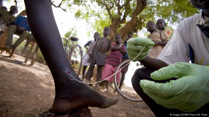 A medical worker extracts a Guinea worm from a child's leg in Ghana