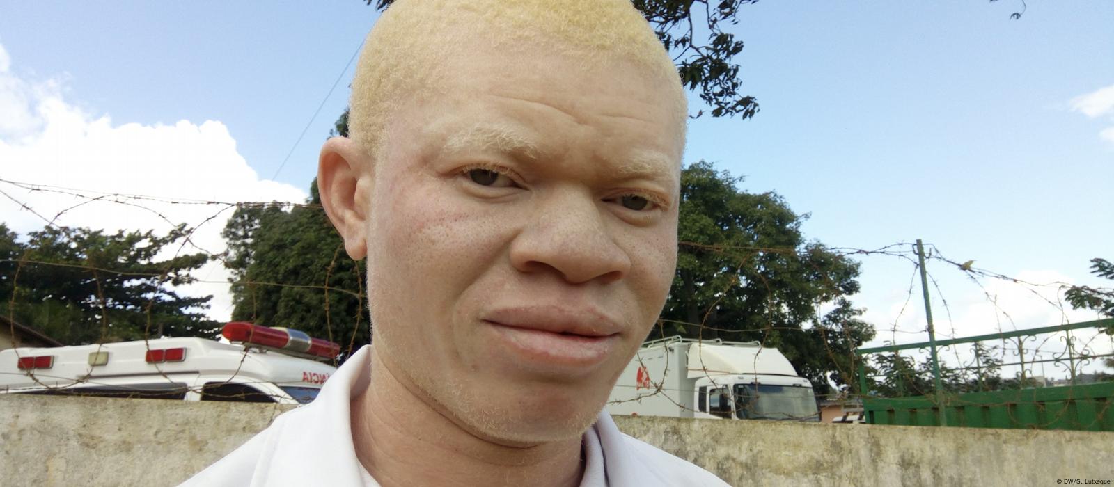 Albino Menschen