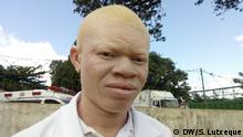 Косъм и прах от албинос: фатални суеверия в Африка