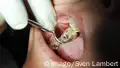 Zahnfüllung mit Amalgam