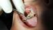 Zahnfüllung mit Amalgam Zahnfüllung mit Amalgam