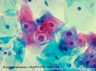 Virus del papiloma en células uterinas.