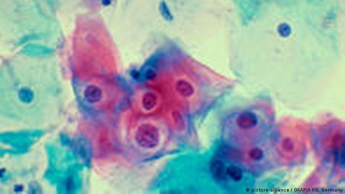 Papillomavirus in Zellen von Gebärmutter