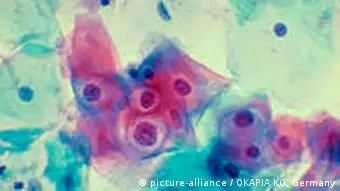 Virus del Papiloma Humano en células uterinas.
