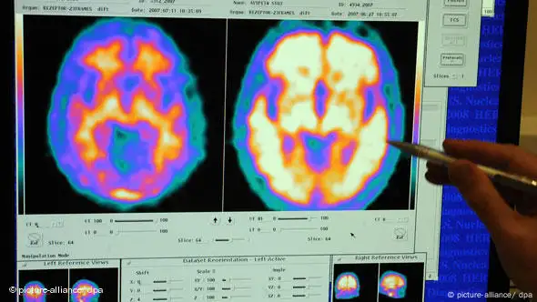 Aufnahmen des Gehirns auf Monitor (Foto: dpa)