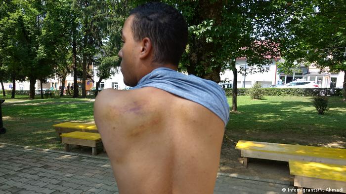A man shows bruises he says were inflicted by Croatian cops