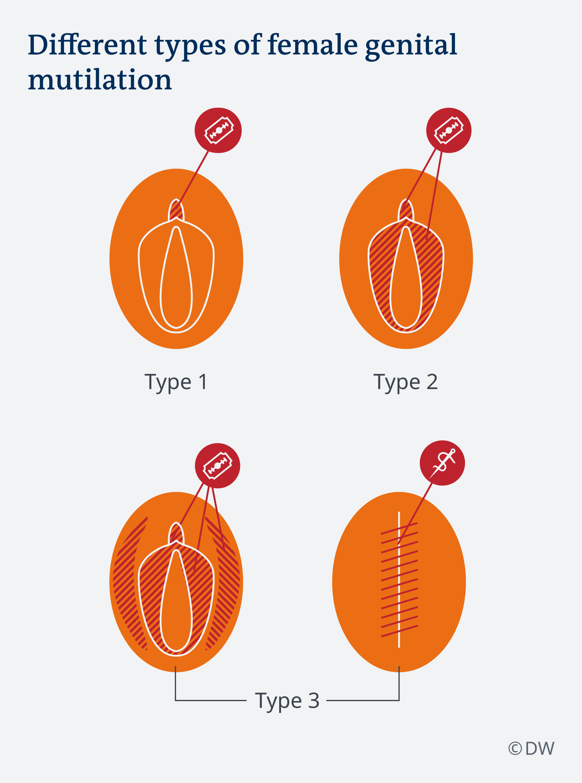 illustration of the four stages of FGM