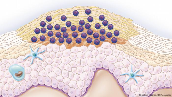 giardiasis vs enterobiasis hpv tumore ano