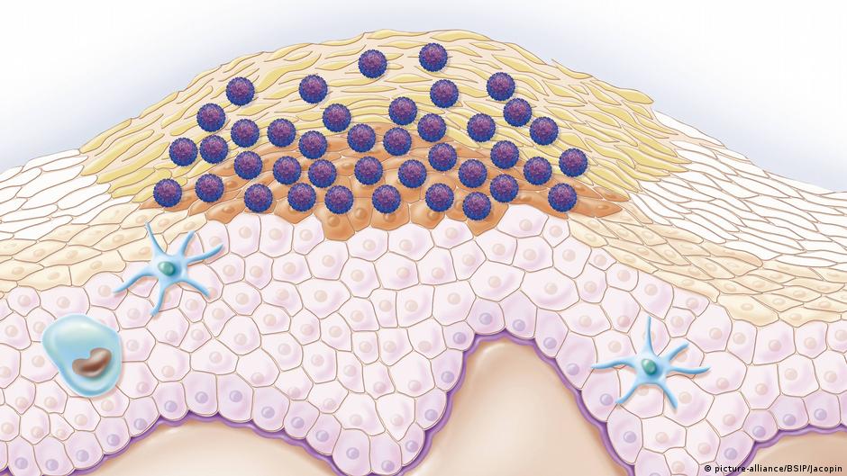 a genitális szemölcsök kezelésének módszere neuroendokrin rák tumor markerek