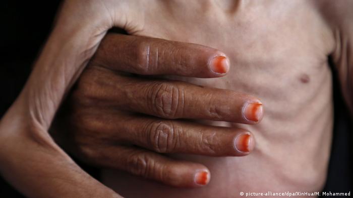 A woman's hand holds a small malnourished child