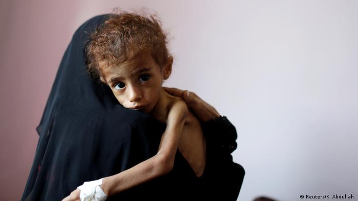 Wiele dzieci jest wskutek wojen niedożywionych, tak jak w Jemenie