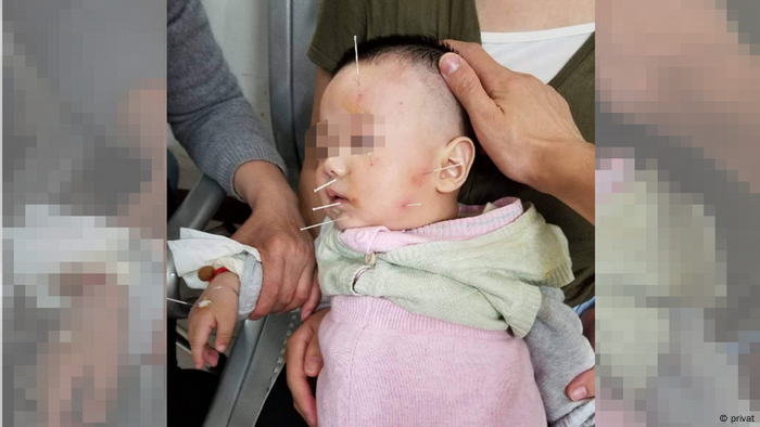 China Impfung Baby Gesichtslähmung