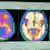 Naukowcy porównują zdjęcia mózgu zdrowego człowieka i chorego na Alzheimera (po prawej)