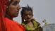 Pakistan Mithi undernourished children Pakistan Mithi undernourished children