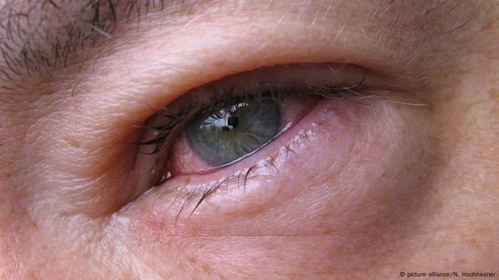 طقوس العين التهاب مؤلم يمكن التخلص منه بوصفات منزلية منوعات نافذة عربية DW على حياة المشاهير والفعاليات المضحكة DW 02 04 2019