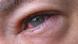stark entzündetes Auge stark entzündetes Auge