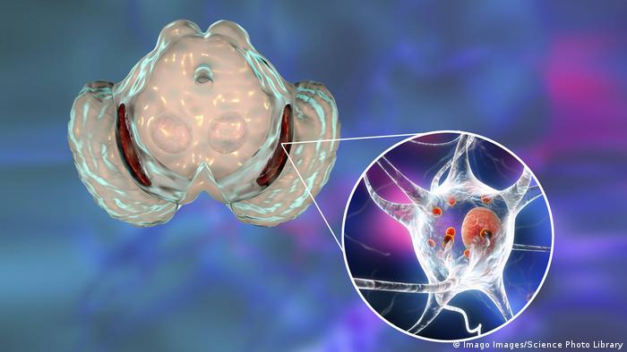 Субстанция нигра - засегнатата част от мозъка при болестта на Паркинсон