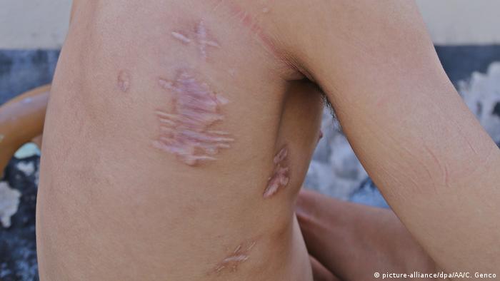Torture marks on a young man who fled from Syria