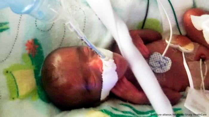 World S Smallest Baby Released From San Diego Hospital News Dw 30 05 2019