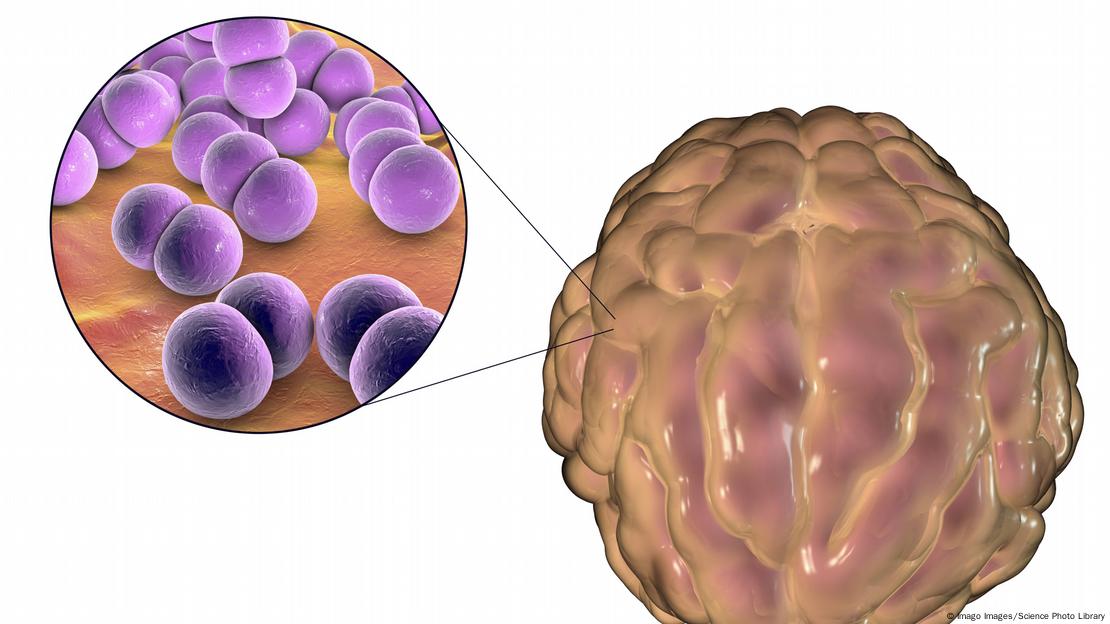 Neisseria meningitidis Infektion