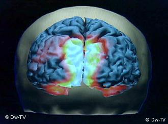 Grafik von einem Gehirn, das bunt in einem Schädel aufleuchtet (Foto: DW-TV)