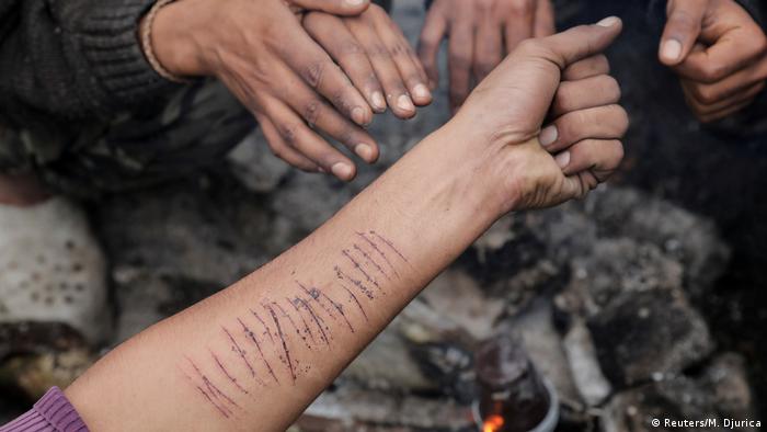 Ein Unterarm, mit parallelen Schnittwunden übersät (Foto: Reuters/M. Djurica)