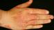 Рука, пораженная псориазом Рука, пораженная псориазом