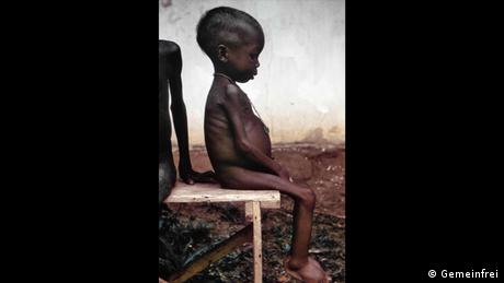 Bildergalerie Biafra-Krieg | Unternährtes Kind (Gemeinfrei)