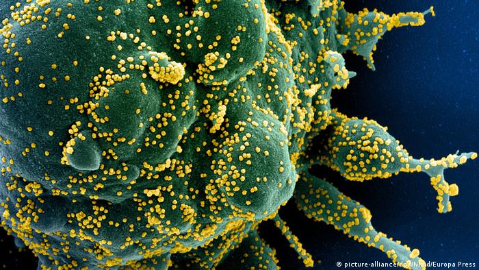 Celula humana (verde) atacada por el coronavirus SARS-CoV-2 (amarillo).