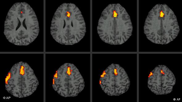 Dengan pemindaian fMRI, dokter dapat melihat daerah otak mana yang aktif pada pasien