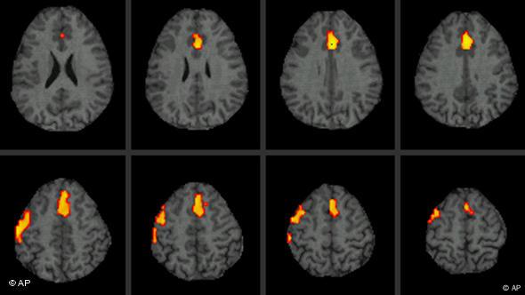 Bran scan - fMRI showing active regions lit up