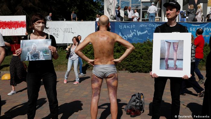 A man showing bruises on his back and legs that he received while in police custody 