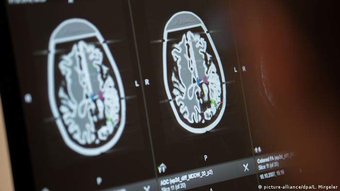 COVID-19 reduce el volumen de materia gris en el cerebro, según estudio 1 (Foto de referencia)