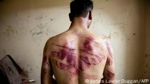 A Syrian man shows marks of torture on his back, after he was released from regime forces, in the Bustan Pasha neighbourhood of Syria's northern city of Aleppo on August 23, 2012. State media hailed the recapture by the army of three Christian neighbourhoods in the heart of Aleppo, but clashes between troops and rebel fighters raged in other parts of the city and in the southern belt of Damascus. AFP PHOTO / JAMES LAWLER DUGGAN (Photo by JAMES LAWLER DUGGAN / AFP)