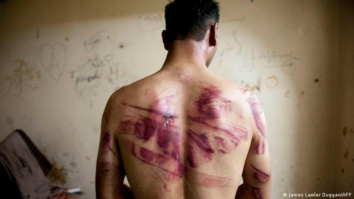 Жертва пыток в сирийской тюрьме: мужчина с кровоподтеками на спине