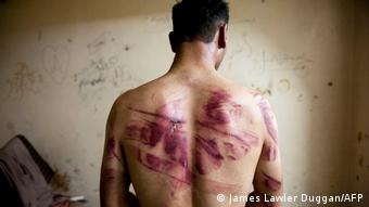 Θύμα βασανιστηρίων από το συριακό καθεστώς