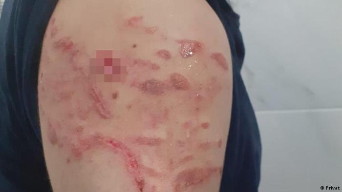 Polis köpeklerinin saldırısından sonra Şeyhmus Yılmaz'ın kolu