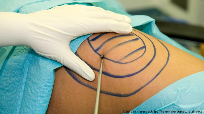 Symbolbild | Schönheit-Operationen: Man sieht die Hautpartie eines Patienten, fürs Fettabsaugen markiert, die behandschuhte Hand eines Arztes und eine Absaugnadel, die ins Gewebe eingestochen werden soll. 
