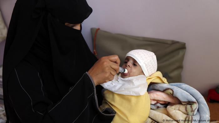  A Yemeni baby receives treatment at a hospital